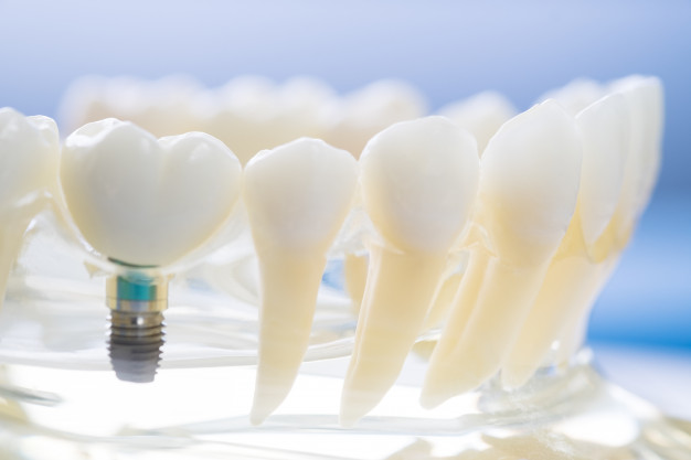 regeneración ósea mediante implante dental