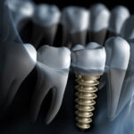 Tu mejor opción para ponerte implantes dentales en Morata de Tajuña es la Clínica Dental Central