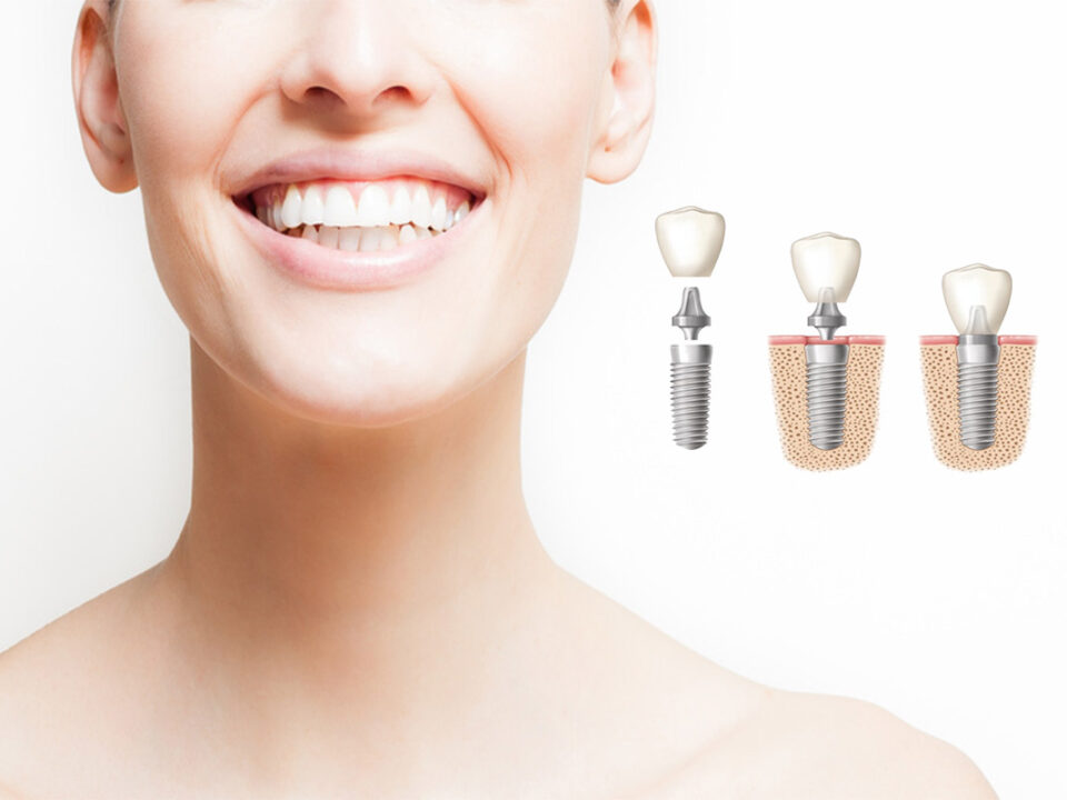 implantes dentales tarancon