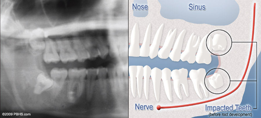 La extracción de las muelas del juicio acarrea un pequeño riesgo de dañar los nervios de la mandíbula.