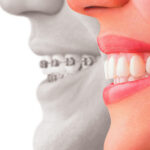 En la ortodoncia lingual tienes una alternativa discreta a la ortodoncia